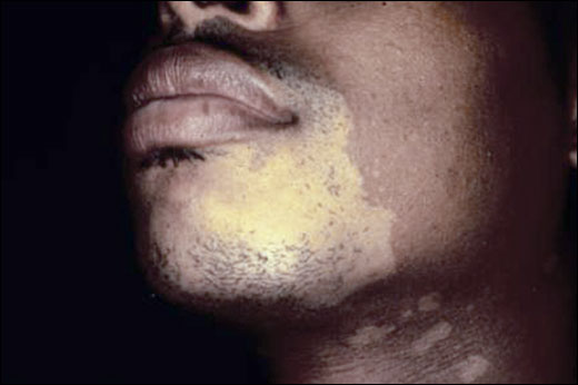 hypopigmented-cutaneous-t-cell-lymphoma-520x346